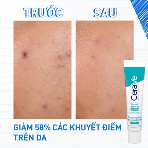 Trước sau CeraVe Blemish Control Gel 40ml